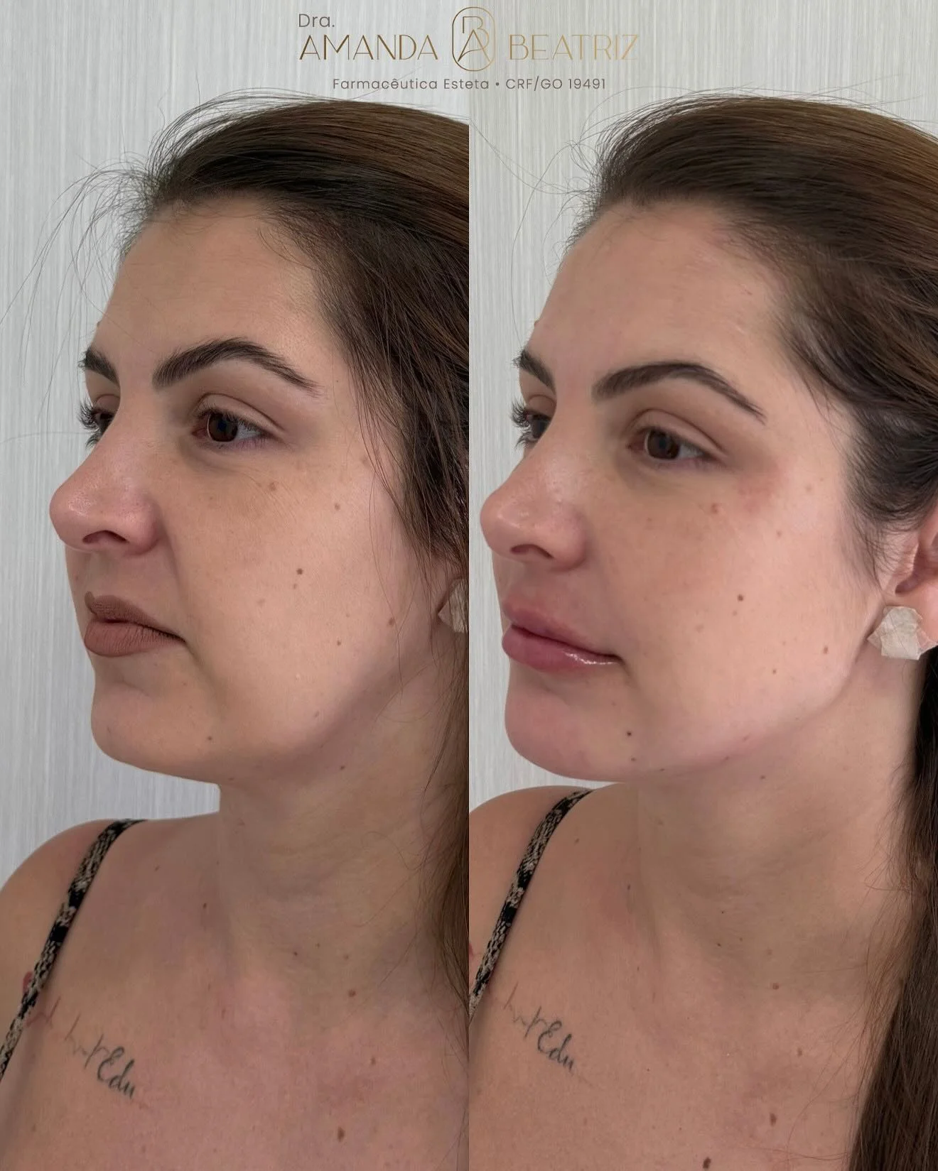 Resultado Preenchimento Labial e Mentoplastia