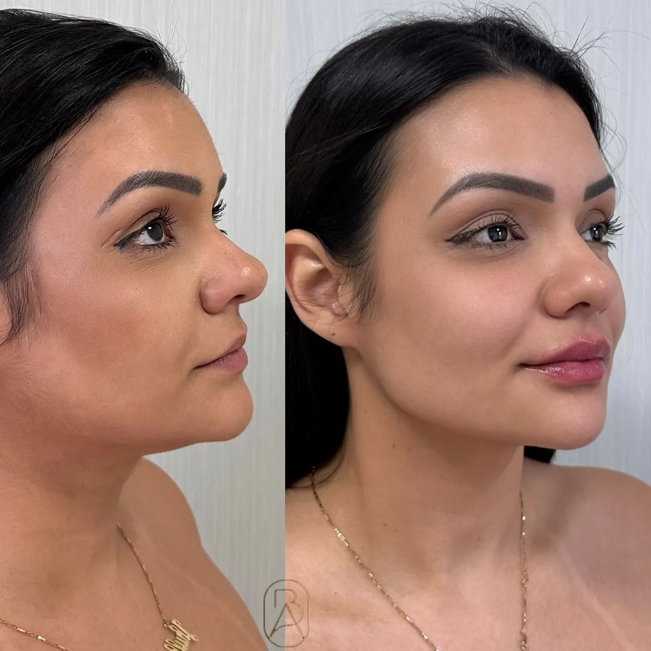 Resultado Preenchimento Labial