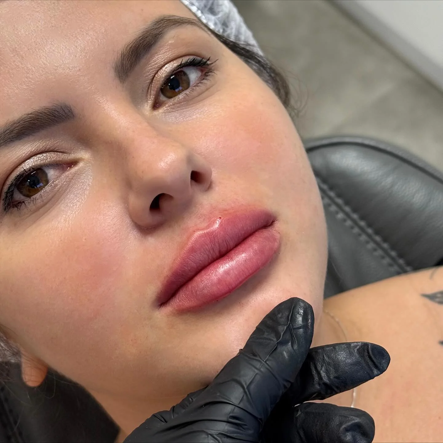 Resultado Preenchimento Labial