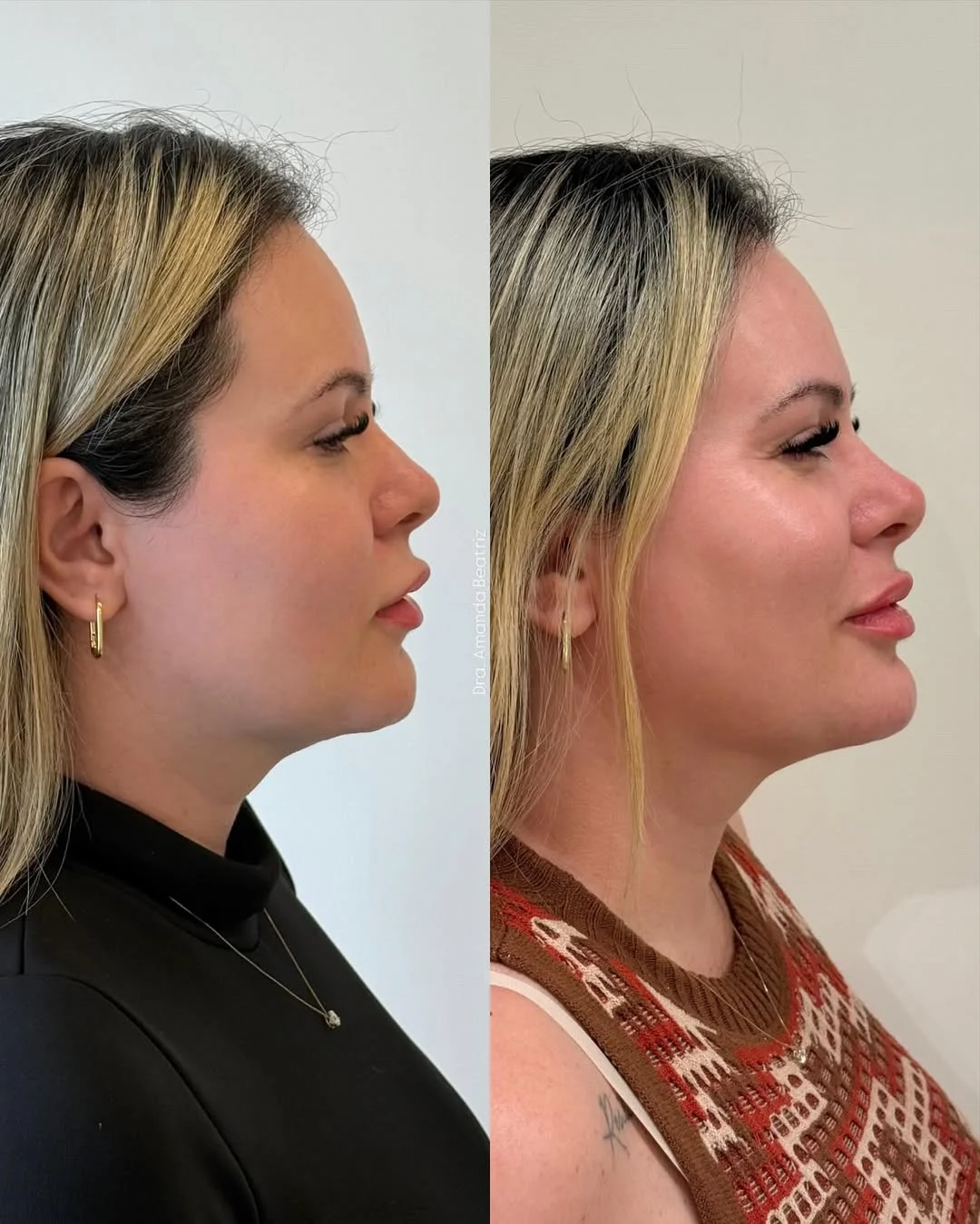 Resultado Preenchimento Labial