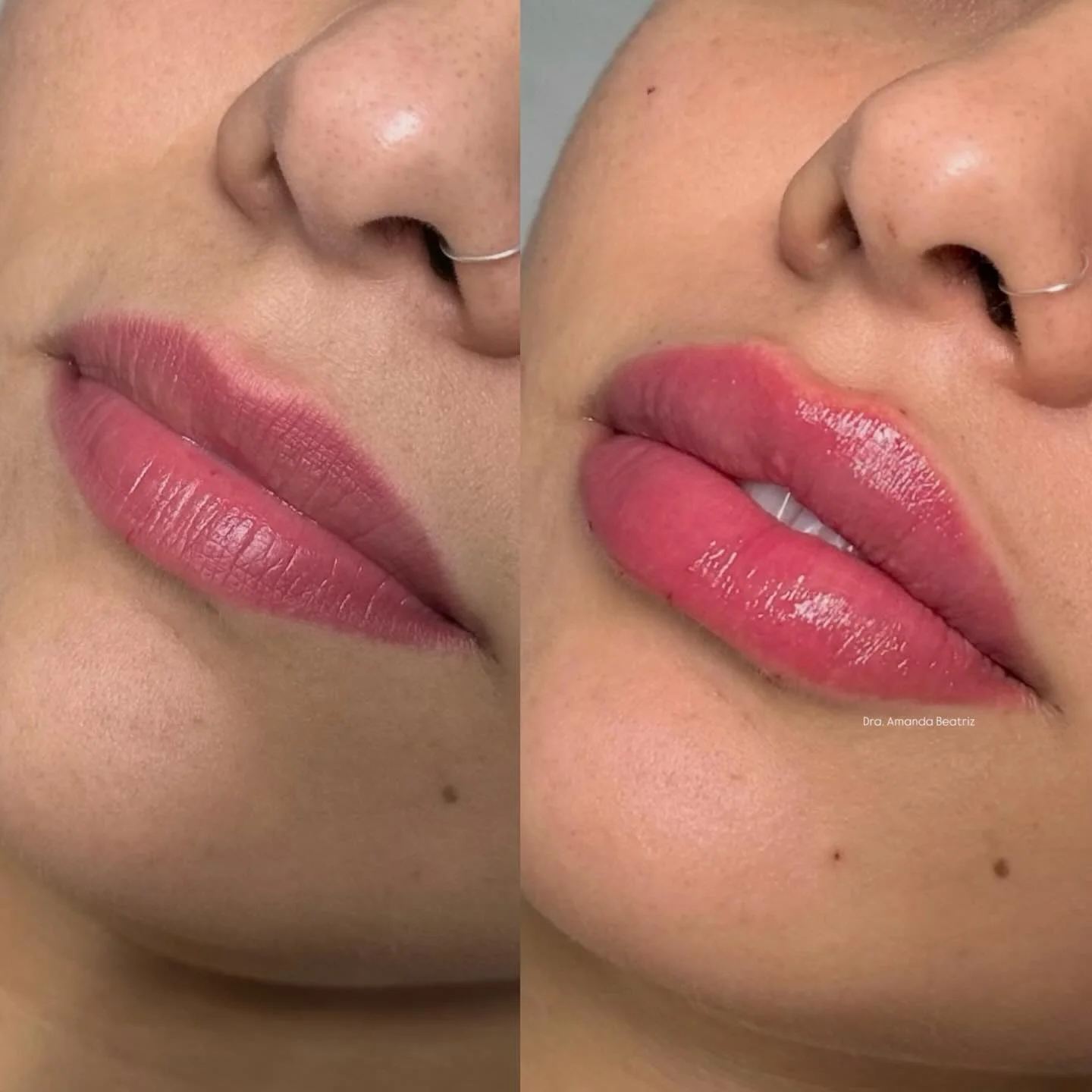 Resultado Preenchimento Labial