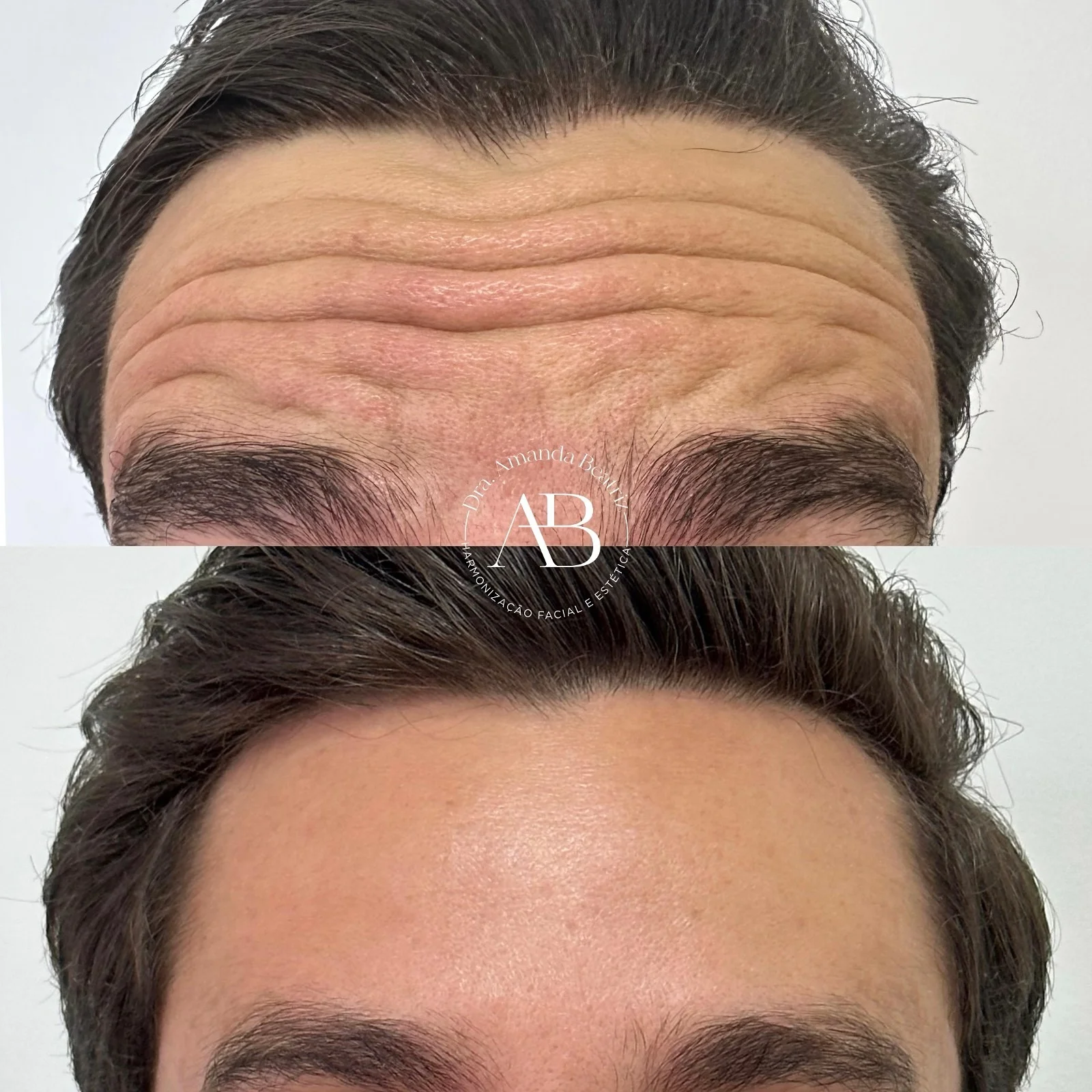 Procedimento Estético Botox Testa