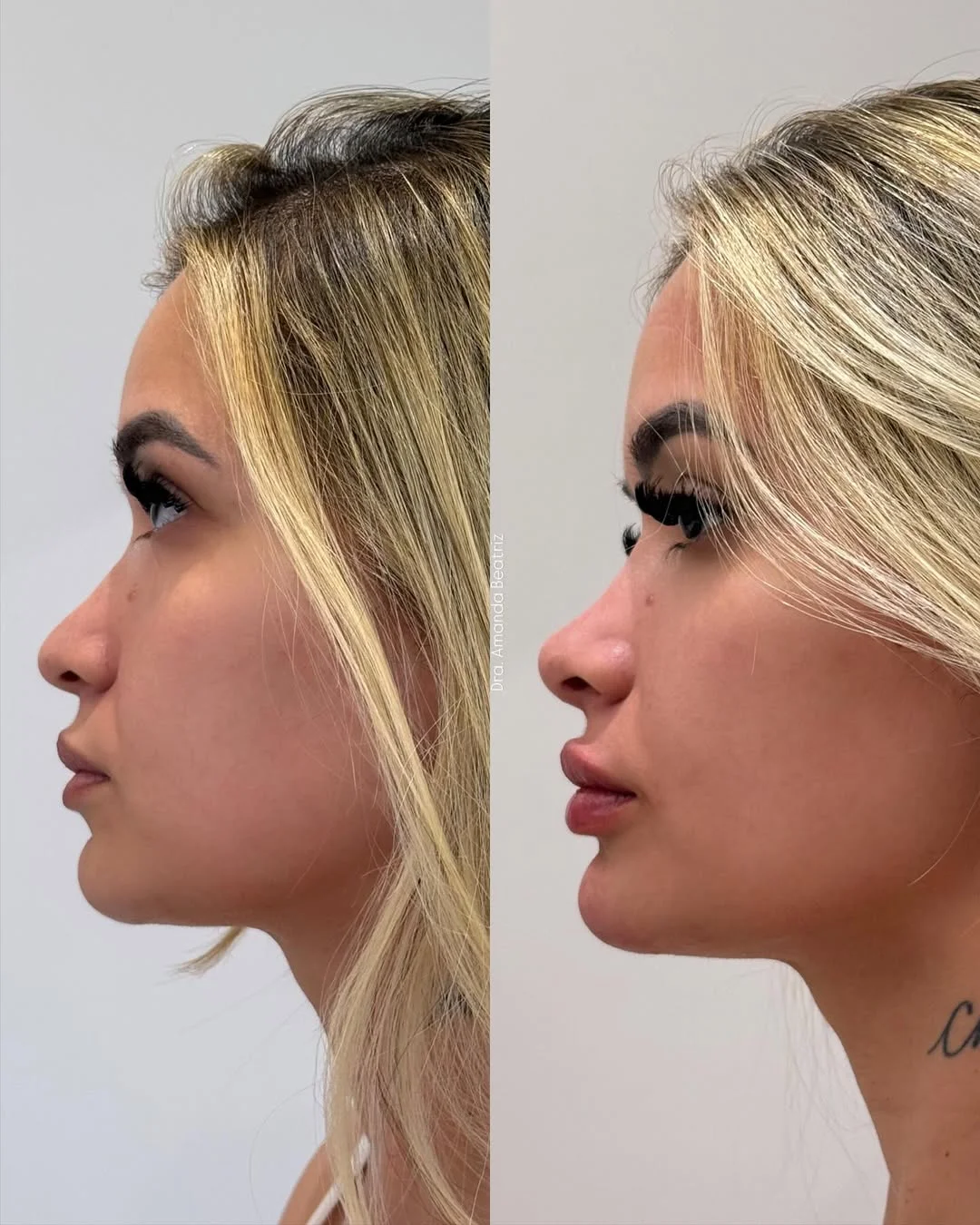 Resultado Rinomodelação, Preenchimento Labial e Mentoplastia