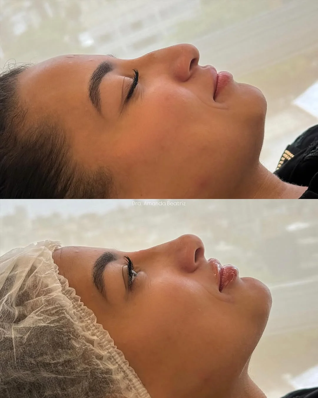 Resultado Rinomodelação, Preenchimento Labial e Mentoplastia