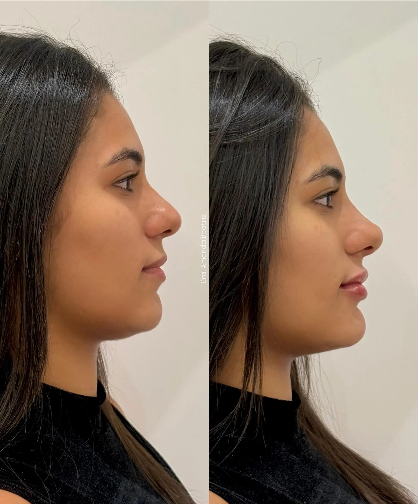 Resultado Rinomodelação, Preenchimento Labial e Mentoplastia