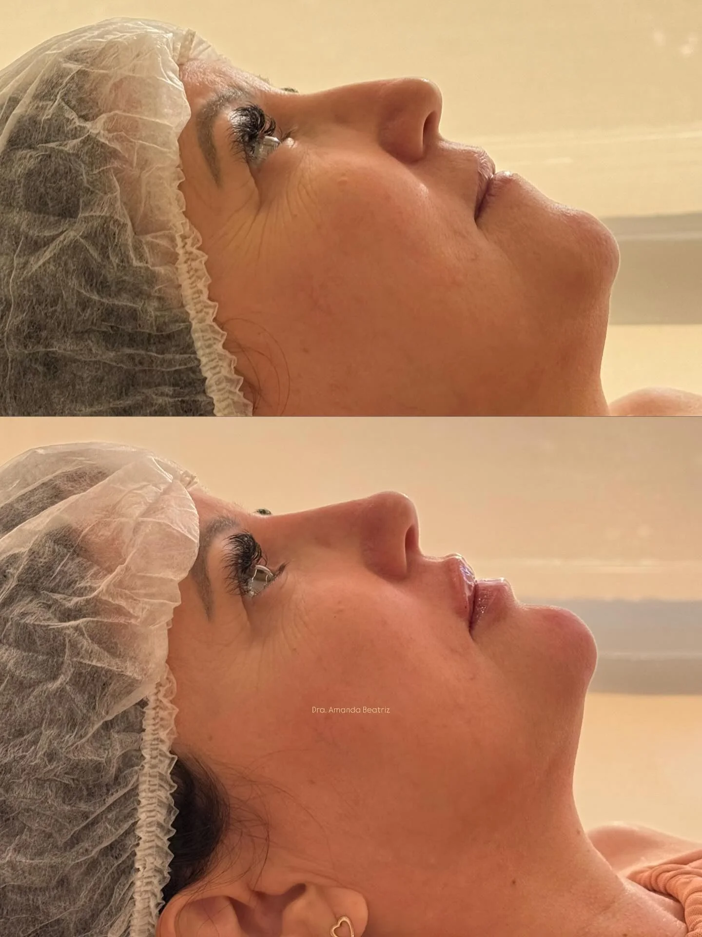 Resultado Rinomodelação, Preenchimento Labial e Mentoplastia