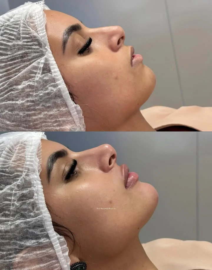 Resultado Rinomodelação, Preenchimento Labial e Mentoplastia