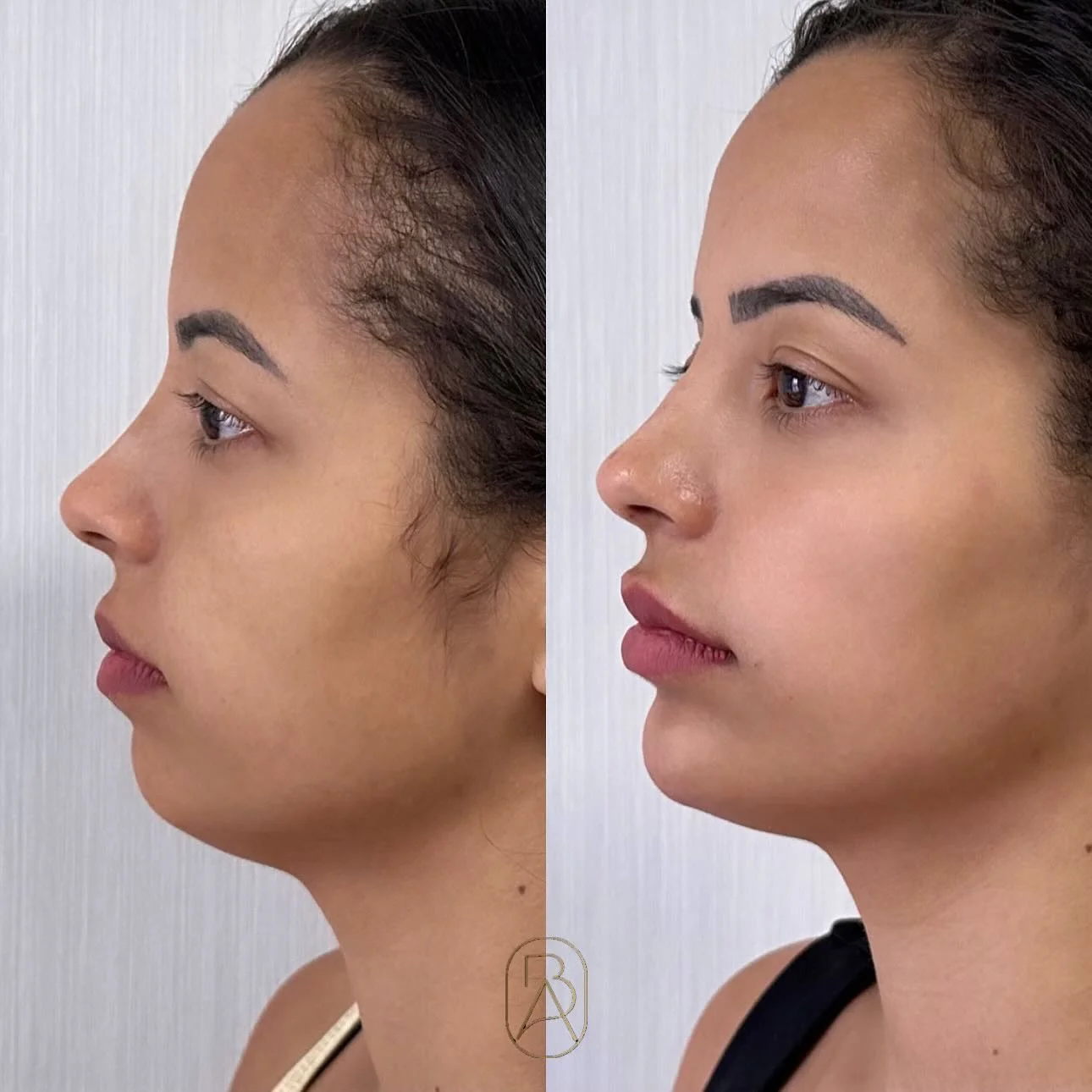 Resultado Rinomodelação, Preenchimento Labial e Mentoplastia