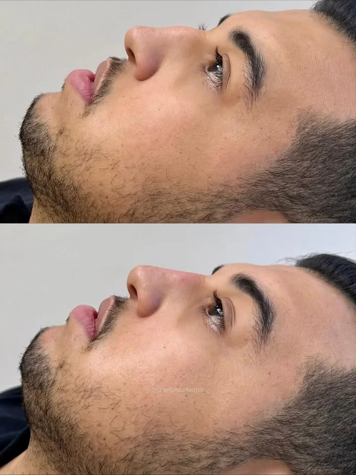 Procedimento Estético Nariz